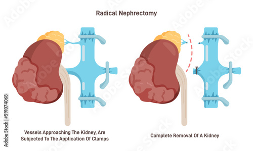 Nephrectomy, surgical removal of a kidney. Diseased swelling kidney