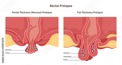 Rectum prolapse. Two types of proctological disease. Human anus