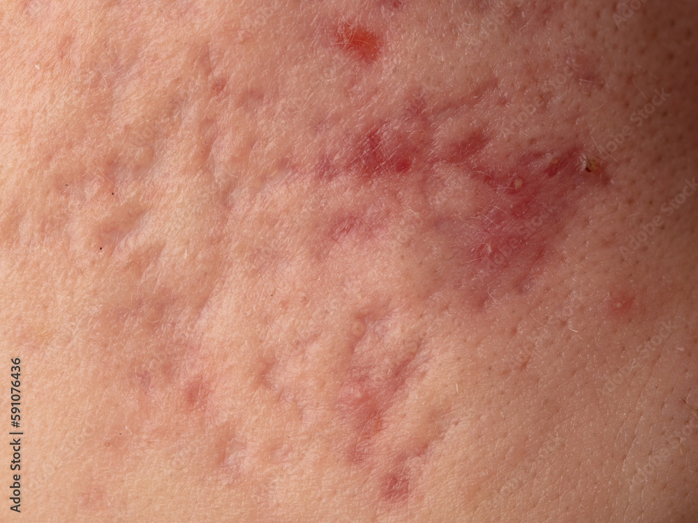 Fototapeta premium Acne scars on the skin. Macro.