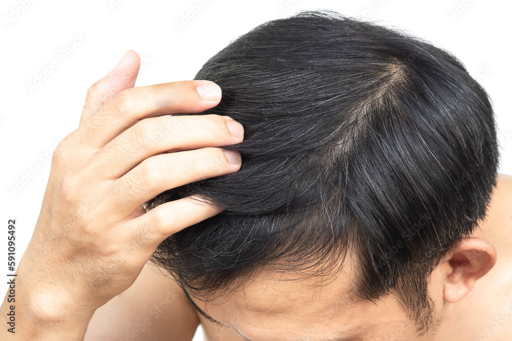 Closeup Young man serious hair loss problem with white backgroun for health care medical and shampoo product concept, selective focus Closeup Young man serious hair loss problem with white backgroun for health care medical and shampoo product concept, selective focus