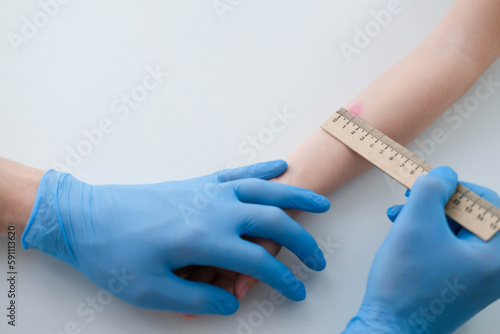 A male doctor makes an important Mantoux test on a child. The doctor measures the Mantoux test with a ruler for a little boy photo