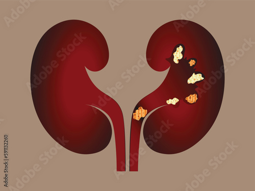 a kidney model with stones in it. kidney treatment banner, poster vector illustration.