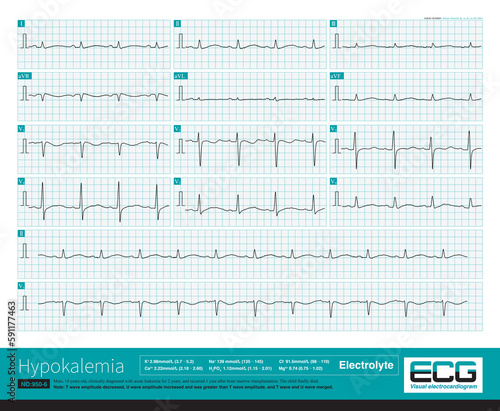 A 14-year-old boy with leukemia developed recurrent ventricular arrhythmias and electrolyte disturbances during hospitalization  and eventually died during hospitalization.
