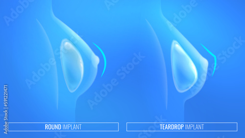 Breast implant types in woman silhouette. Infographic of types of breasts after mammoplasty. Vector illustration of the result of breast augmentation