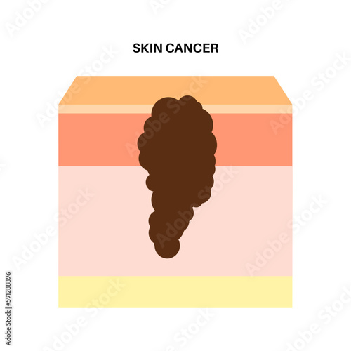 Skin cancer anatomy