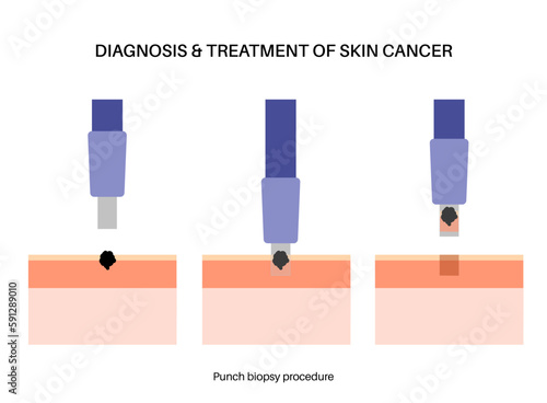 Punch biopsy procedure