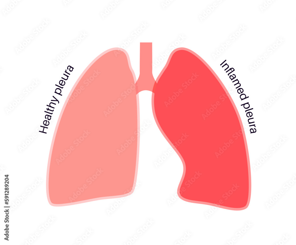Fototapeta premium Pleurisy inflammation diseases