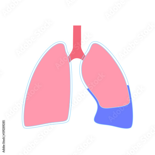 Pleural effusion poster