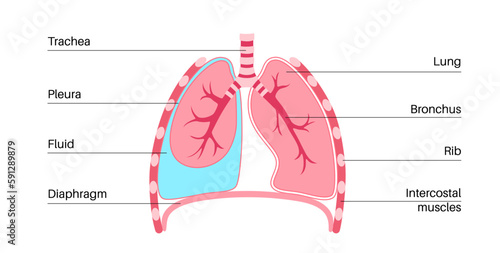 Pleural effusion poster
