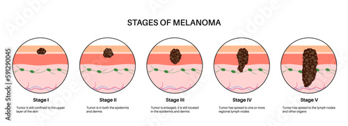 Melanoma stages poster