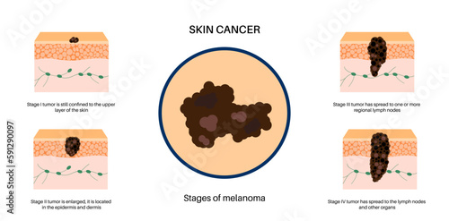 Melanoma stages poster