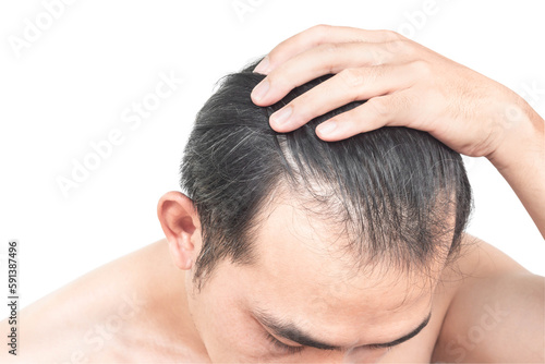 Closeup Young man serious hair loss problem with white backgroun for health care medical and shampoo product concept, selective focus