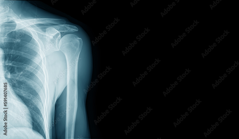 x-ray image of shoulder for medical diagnosis