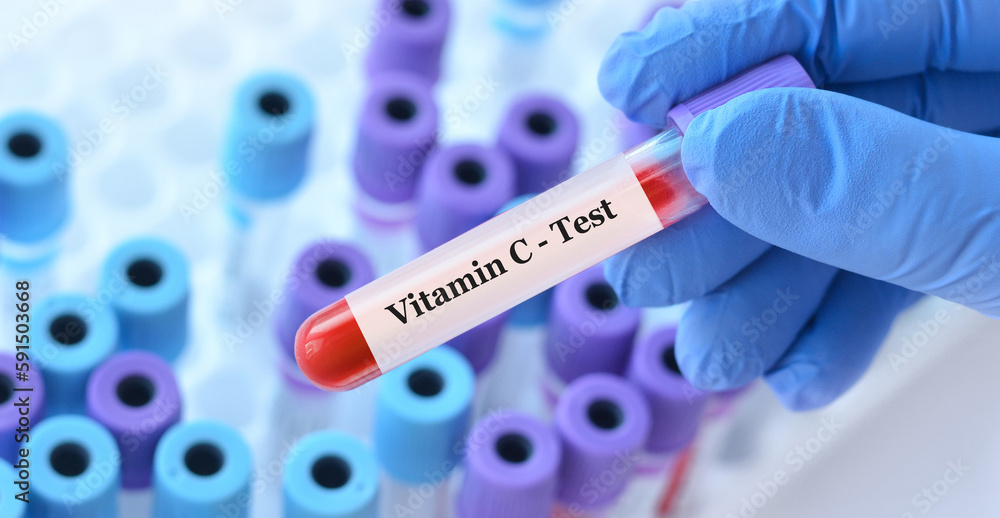 Obraz premium Doctor holding a test blood sample tube with Vitamin С test on the background of medical test tubes with analyzes.Banner.Copy space for text