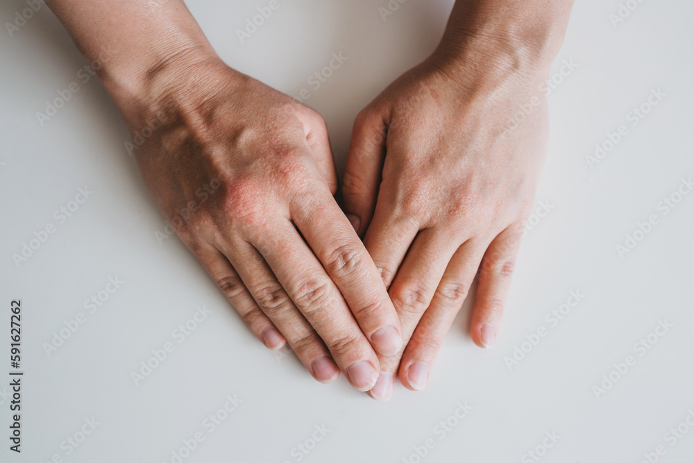 Fototapeta premium Rashes on the skin of a young woman's hands. Skin itching, eczema, skin allergies.