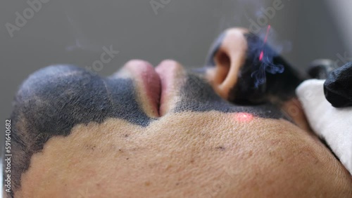 Skin care cosmetology. Laser therapy and skin treatment. Carbon face peeling procedure. Closeup of the laser pulses clean skin of the face. Hardware cosmetology treatment. Process of warming the skin