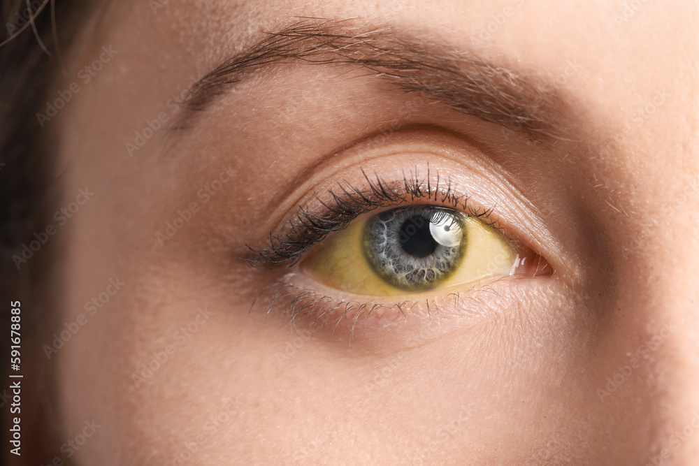 Obraz premium Young woman with yellow eyes, closeup. Hepatitis symptom