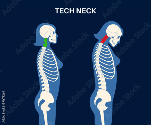 Neck vertebrae deformity
