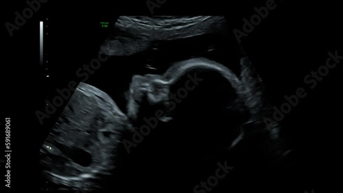 ultrasound of a 6 month pregnant baby inside the womb where you can see his face and leg