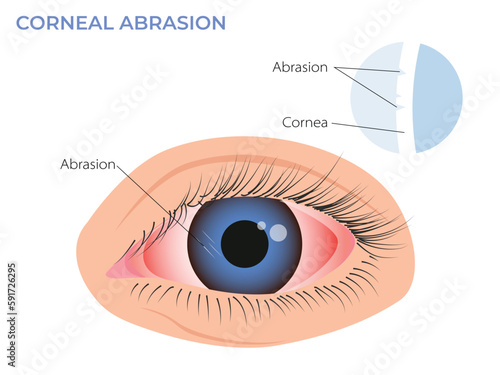 Corneal abrasion illustration. Eye redness symptom. pink red surfer's eye photo