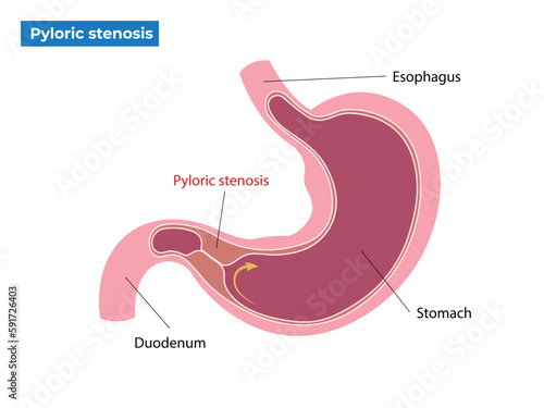 Symptoms of pyloric stenosis vector illustration photo