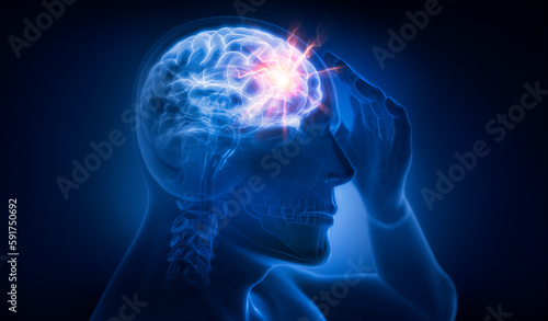 Man with heavy headache - 3D illustration