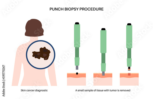 Punch biopsy procedure