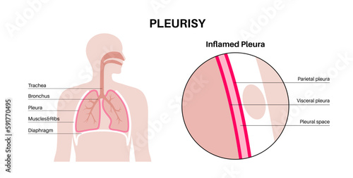 Pleurisy inflammation diseases