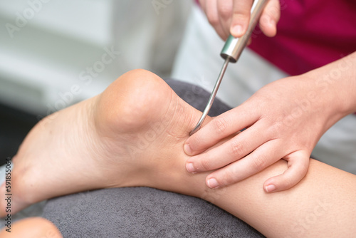  Skilled female physical therapist performing diacutaneous fibrolysis technique on patient s foot
