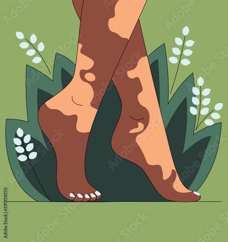 Vitiligo bare legs of woman. with manicure