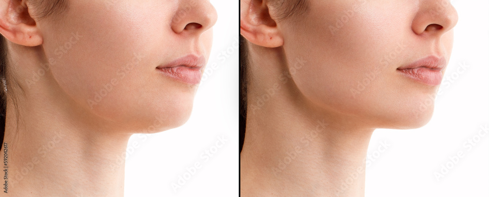 A close portrait of a woman before and after the facial rejuvenation procedure. Correction of the chin shape liposuction of the neck. Fillers in the cheekbones and chin. The result of the procedure in - obrazy, fototapety, plakaty 