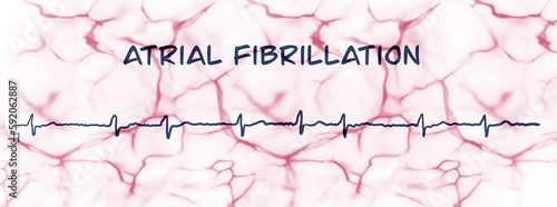 ECG example of atrial fibrillation