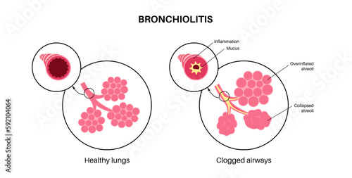 Bronchiolitis lung disease