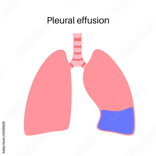 Pleural effusion poster