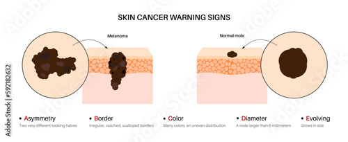 Melanoma warning signs