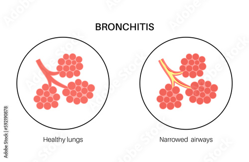 Bronchitis lung disease