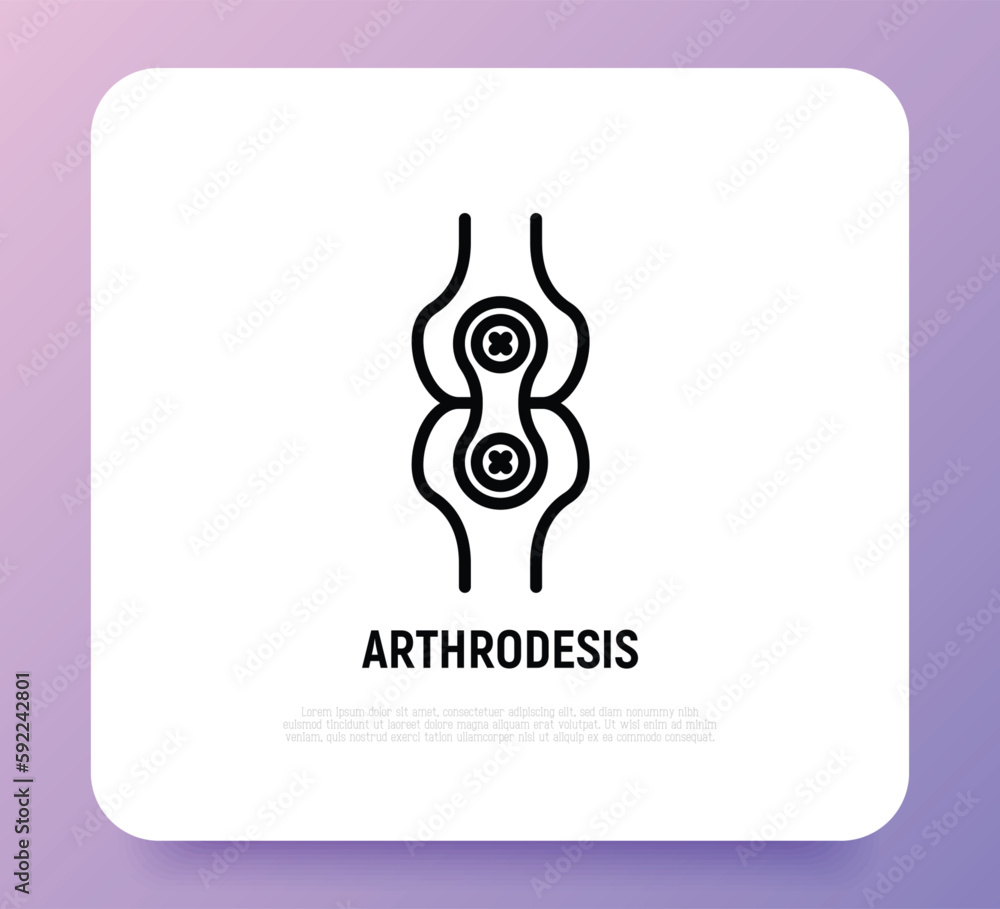 Obraz premium Arthrodesis joint surgery thin line icon. Arthritis. Vector illustration.
