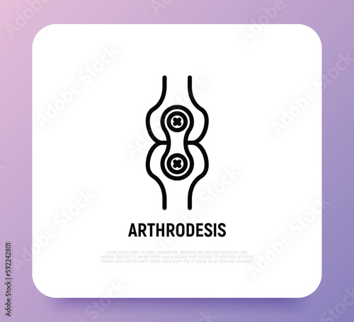 Arthrodesis joint surgery thin line icon. Arthritis. Vector illustration.