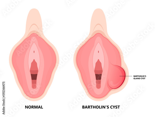 Bartholin’s cyst of vagina pain lump mass with E. coli bacteria sex safe pelvic exam cervix swollen pus lips vulva blockage photo