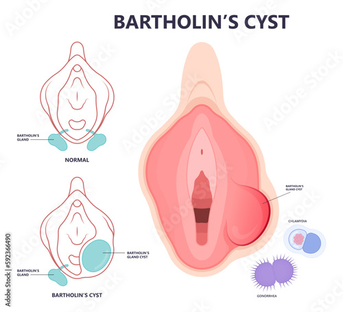 pelvic exam pain Bartholin’s cyst of vagina lump mass with E. coli bacteria sex safe cervix swollen pus lips vulva blockage