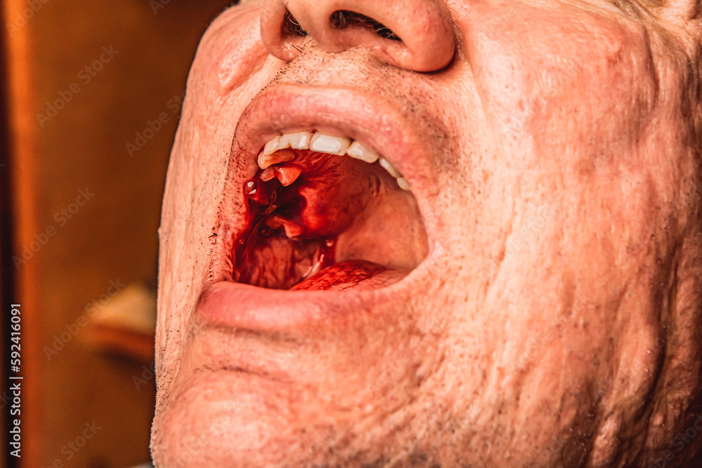 Obraz premium Close up man open mouth, jaw with teeth, detailed sealed bloody tooth after surgery in dental clinic. Tooth extraction treatment. Caries removing, nerve removal canals. Wisdom tooth, severe bleeding