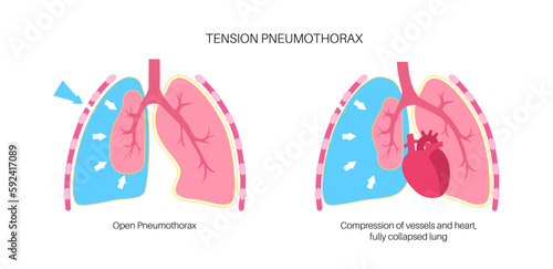 Tension pneumothorax poster
