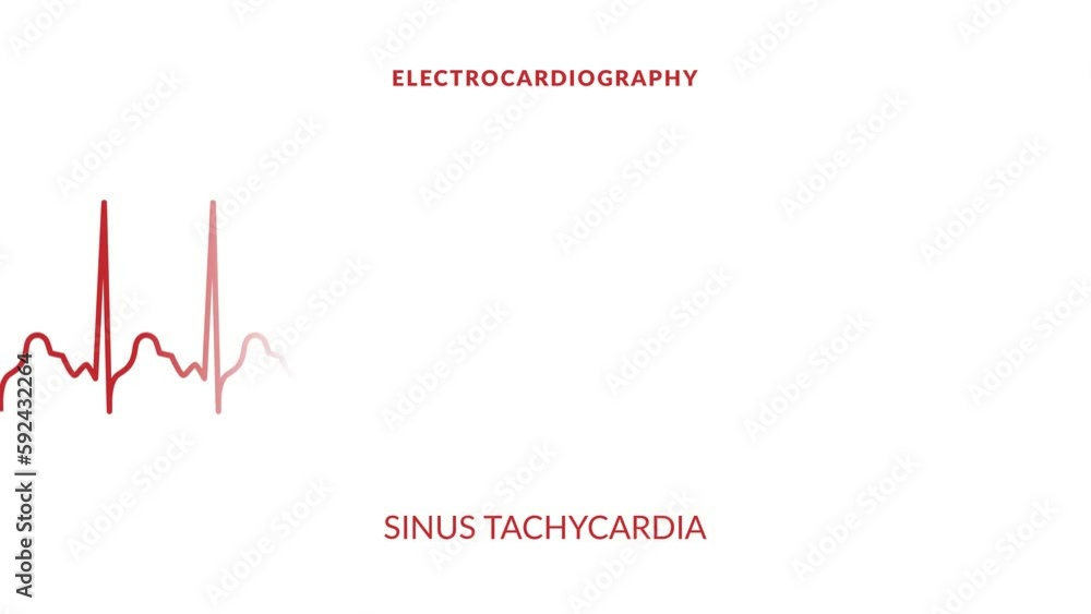 animated sinus tachycardia. animated ekg display animated sinus tachycardia. animated ekg display