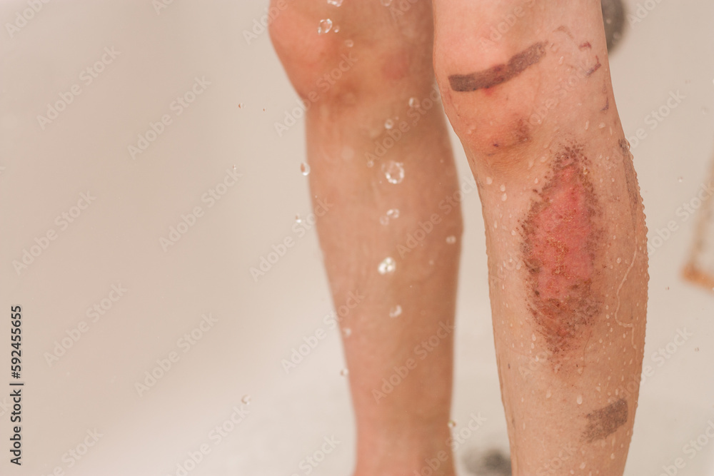 Fototapeta premium quemadura