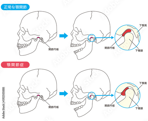 正常な顎関節と顎関節症の比較 photo