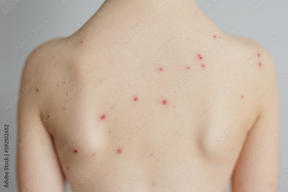 Naklejka premium Close-up of naked back of child with pimples of chickenpox