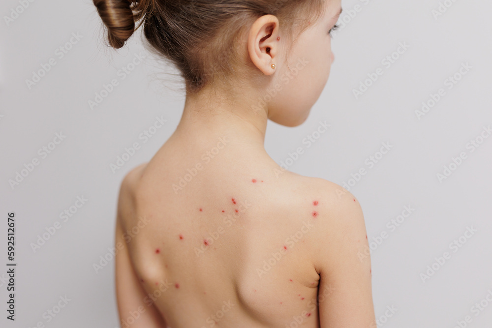 Close-up of naked back of little child with pimples of chickenpox Close-up of naked back of little child with pimples of chickenpox