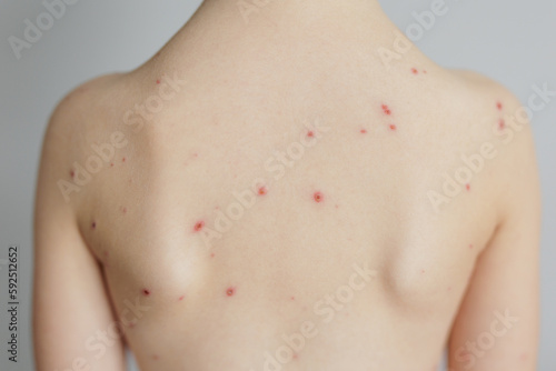 Close-up of naked back of child with pimples of chickenpox