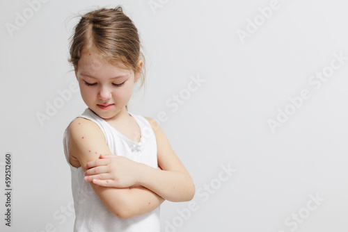 Portrait of child with pimples of chickenpox with copy space