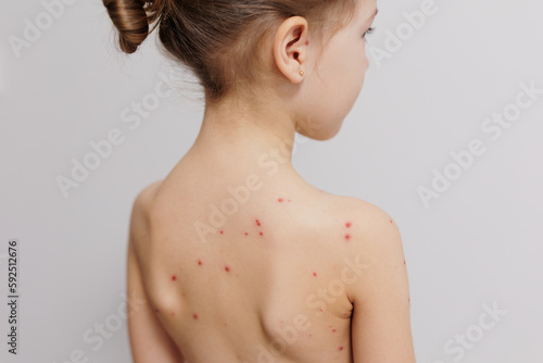 Close-up of naked back of little child with pimples of chickenpox